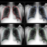 AI vs. Humans: AI Solution Beats Stanford Radiologists In Chest X-ray Diagnostics Competition