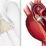 FDA Approves TAVR for Low-risk Patients Creates A Paradigm Shift in Cardiology