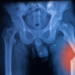 RSIP Vision Launches AI-Based, 3D Total Hip Replacement Solution