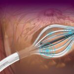 Brachytherapy catheters Market Insights, Potential Business Strategies, Mergers and Acquisitions, Revenue Analysis – 2020– 2028