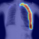 RADLogics Secures FDA Clearance for AI-Powered Chest X-Ray App for Triage & Prioritization