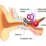 Labyrinthitis Market 2021 Industry Insights by Global Share
