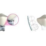 LightForce Orthodontics Secures $50M for Customized, 3D Printed Orthodontic Solutions