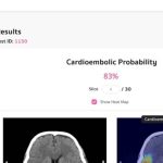 Thai Researchers Develop AI for Assessing Stroke Risk and More Briefs