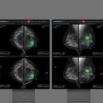 Lunit Acquires AI-Enabled Breast Cancer Detection Platform Volpara for $193M.